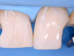 Direct and Indirect Adhesive Restorations