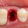 Extraction Socket – Preservation/Grafting; Immediate vs Delayed Implants; Pontic Site Development