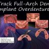 Full-Arch Dentistry – Implant Overdentures