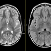 MRIOnline Imaging Mastery Series: Neurocutaneous Syndromes 2021 (CME VIDEOS)