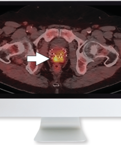 Molecular Imaging and Therapy of Prostate Cancer 2020 (CME VIDEOS)