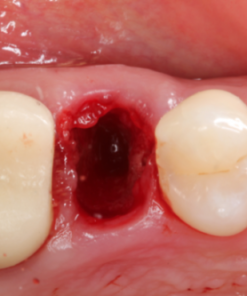 Gidedental Extraction Socket – Preservation/Grafting; Immediate vs Delayed Implants; Pontic Site Development 2020 (CME VIDEOS)