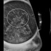 MRIOnline Imaging Mastery Series: High Risk Screening Breast MRI 2021 (CME VIDEOS)