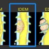 MRIOnline MRI Mastery Series: Intradural Extramedullary Lesions (IDEM) 2020 (CME VIDEOS)