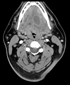 MRIOnline Imaging Mastery Series: Pathology of the Oral Cavity and Oropharynx 2020 (CME VIDEOS)