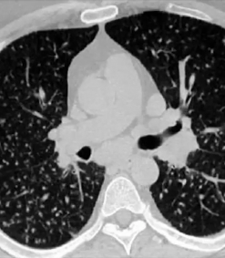 MRIOnline Imaging Mastery Series: Micronodules 2021 (CME VIDEOS)