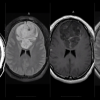 MRIOnline Imaging Mastery Series: Adult Glioma Imaging 2021 (CME VIDEOS)