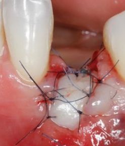 Soft Tissue Management around Natural Teeth and Dental Implants: Fundamentals, Evidence Based and Surgical Innovations