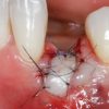 Gidedental Soft Tissue Management around Natural Teeth and Dental Implants 2020 (CME VIDEOS)