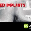 Tilted Implants: A Complete Surgical and Theoretical Guide to Tilted Implants