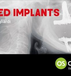 Tilted Implants: A Complete Surgical and Theoretical Guide to Tilted Implants