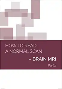 How to Read a Normal Scan: BRAIN MRI PART 2 (High Quality Image PDF)