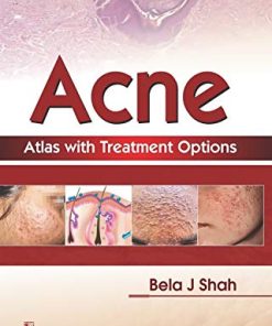 Acne Atlas with Treatment Options (PDF)