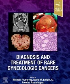 Diagnosis and Treatment of Rare Gynecologic Cancers (PDF)