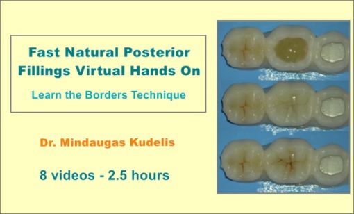 Fast Natural Posterior Fillings Virtual Hands On