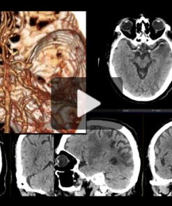 Imaging Acute Stroke: A Comprehensive Review for Clinical Practice 2023