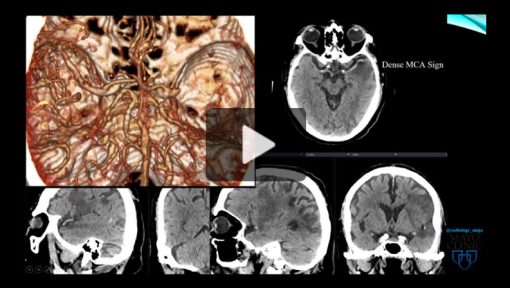 Imaging Acute Stroke: A Comprehensive Review for Clinical Practice 2023