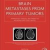 Brain Metastases from Primary Tumors, Volume 3: Epidemiology, Biology, and Therapy of Melanoma and Other Cancers