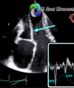 Mastering Constrictive Pericarditis – AllAboutUltrasound 2022 (Complete HTML)