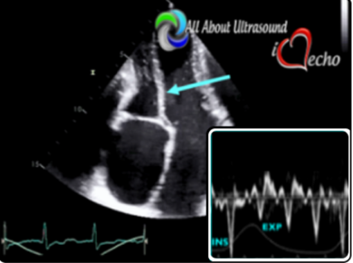Mastering Constrictive Pericarditis – AllAboutUltrasound 2022 (Complete HTML) Mastering Constrictive Pericarditis – AllAboutUltrasound 2022 (Complete HTML)