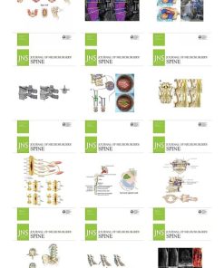 Journal of Neurosurgery: Spine 2022 Full Archives (PDF)