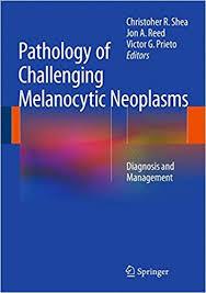 Pathology of Challenging Melanocytic Neoplasms: Diagnosis and Management