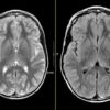 MRIOnline Mastery Series: Neurofibromatosis Type 1 (NF1) 2021 (CME VIDEOS)