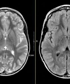 MRIOnline Mastery Series: Neurofibromatosis Type 1 (NF1) 2021 (CME VIDEOS)