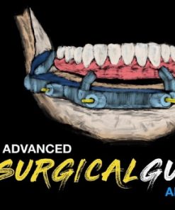 Implant Ninja, Advanced Surgical Guides – All on X – Dental Videos