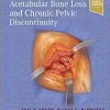 Treatment of Acetabular Bone Loss and Chronic Pelvic Discontinuity (PDF)