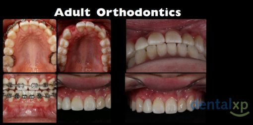 DentalXP Adult Orthodontics