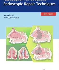 Nasoseptal Perforations: Endoscopic Repair Techniques (EPUB)