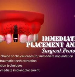 OHI-S Immediate Implant Placement and Loading Surgical Protocols (Course)