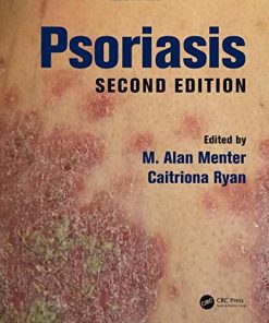 Psoriasis, Second Edition (EPUB)