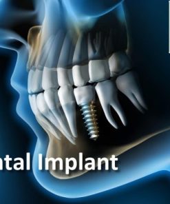 The Dental Vortex – Dental Implant (Course)