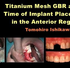 Titanium Mesh GBR at the Time of Implant Placement in the Anterior Region (Course)