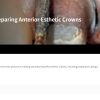 Classic Collection: Preparing Anterior Esthetic Crowns