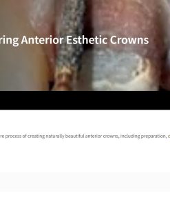 Classic Collection: Preparing Anterior Esthetic Crowns