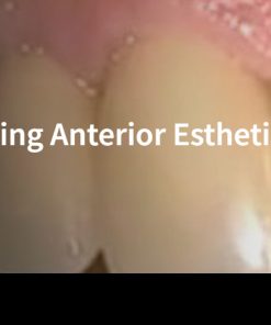 Classic Collection: Cementing Anterior Esthetic Crowns