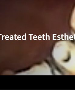 Classic Collection: Endo Treated Teeth Esthetic Management