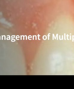 Classic Collection: Esthetic Management of Multiple Missing Anterior Teeth