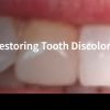 Case Study: Margaret –  Restoring Tooth Discoloration and Alignment