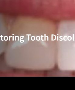 Case Study: Margaret –  Restoring Tooth Discoloration and Alignment