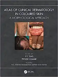 Atlas of Clinical Dermatology in Coloured Skin: A Morphological Approach (PDF) Atlas of Clinical Dermatology in Coloured Skin: A Morphological Approach (PDF)