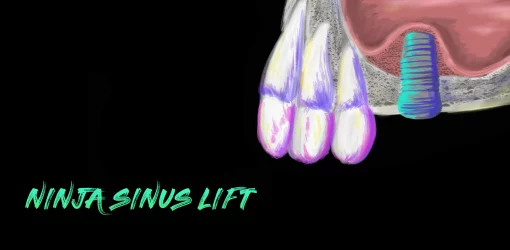 Ninja Sinus Lift (Course)