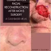 Combination Facial Reconstruction after Mohs Surgery: A Case Based Atlas (PDF)