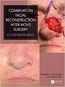 Combination Facial Reconstruction after Mohs Surgery: A Case Based Atlas (PDF)