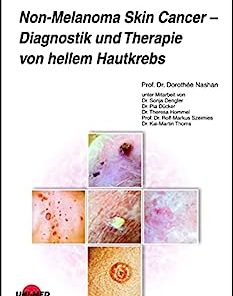 Non-Melanoma Skin Cancer – Diagnostik und Therapie von hellem Hautkrebs (UNI-MED Science) (German Edition) (PDF)