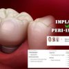 OHI-S Implantation Without Peri-Implantitis (Course)