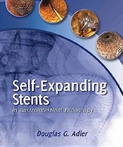 Self-Expanding Stents in Gastrointestinal Endoscopy (PDF)